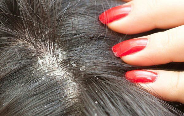 cara menghilangkan ketombe di rambut